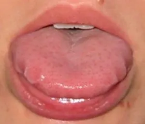 langue-gonflée.jpg