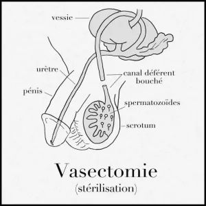 vasectomie-800x800.jpg