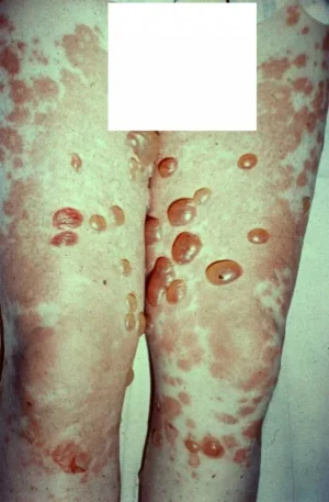 dermatose.jpg