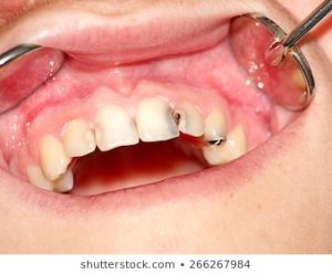 carious-front-teeth-upper-jaw-260nw-266267984.jpg