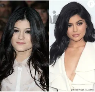 2230663-kylie-jenner-avant-et-apres-la-chirurgie-624x600-1.jpg