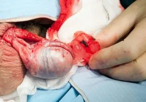 testicule-torsion-sante-tunisie-testiculaire.jpg