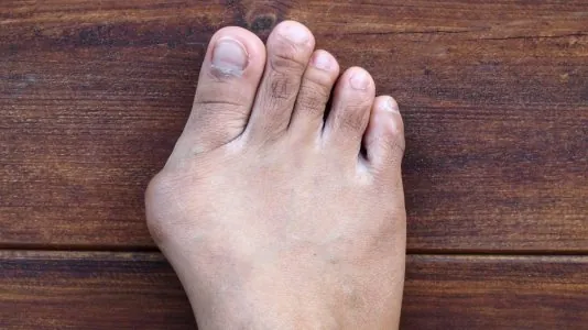 i104851-hallux-valgus-pm.jpg