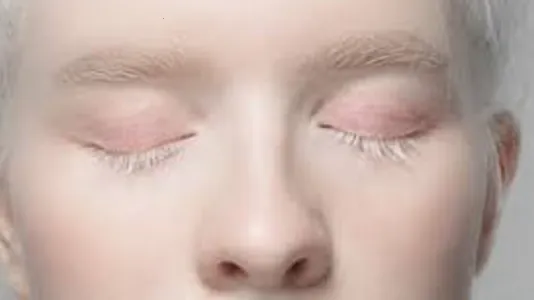 albinisme slider (1).png
