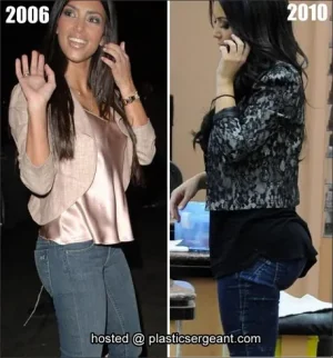 kim-kardashian-butt-augmentation.jpg
